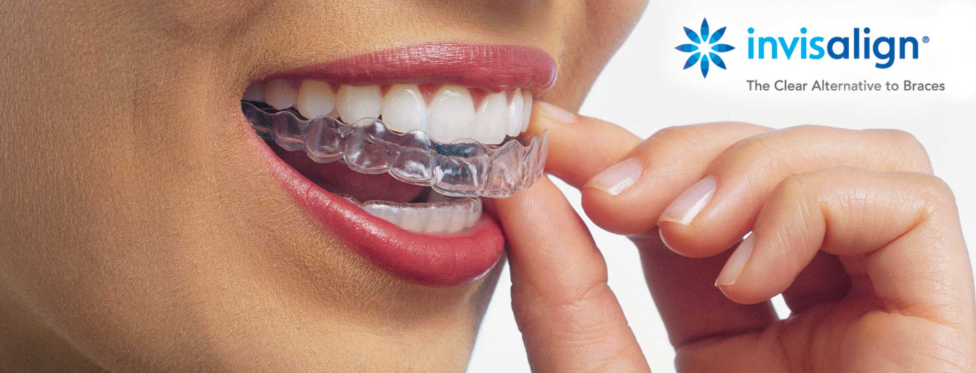 invisalign hartsdale