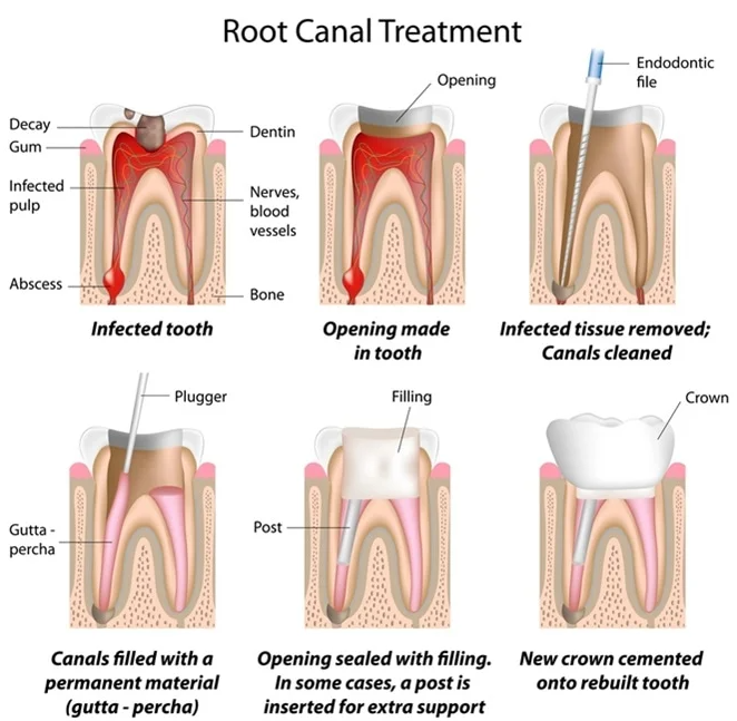 root canal treatment scarsdale